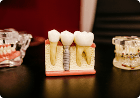 maqueta de implantes dentales